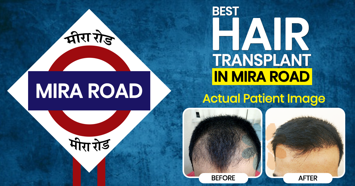 Hair Transplant in Mira Road