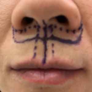 Pre-op lip lift markings on a patient